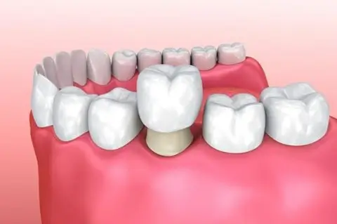 Phục hình cố định