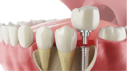 Implant