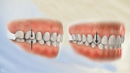 Điều Trị Cắn Khớp